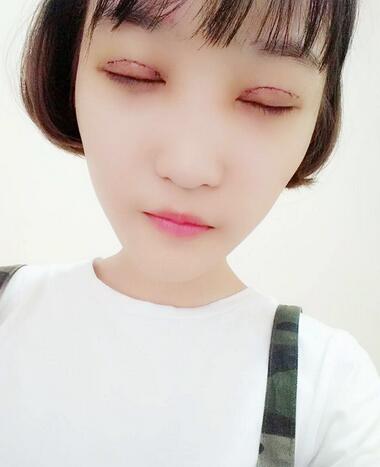 切开双眼皮恢复全过程