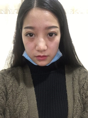 海南瑞韩刘申松做的隆鼻整形手术，附上前后对比图片