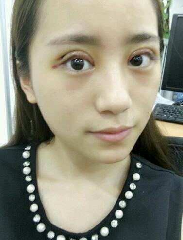 割双眼皮案例图片 双眼皮手术20天