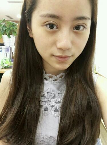 割双眼皮案例图片 双眼皮手术20天