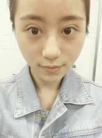 割双眼皮案例图片 双眼皮手术20天