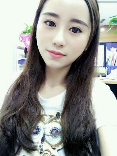 割双眼皮案例图片 双眼皮手术20天