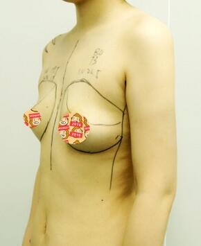 自体脂肪丰胸恢复正常需要多久 我的经历告诉你