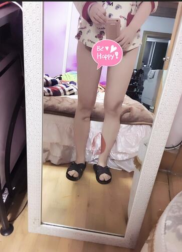 自体脂肪丰胸恢复正常需要多久 我的经历告诉你