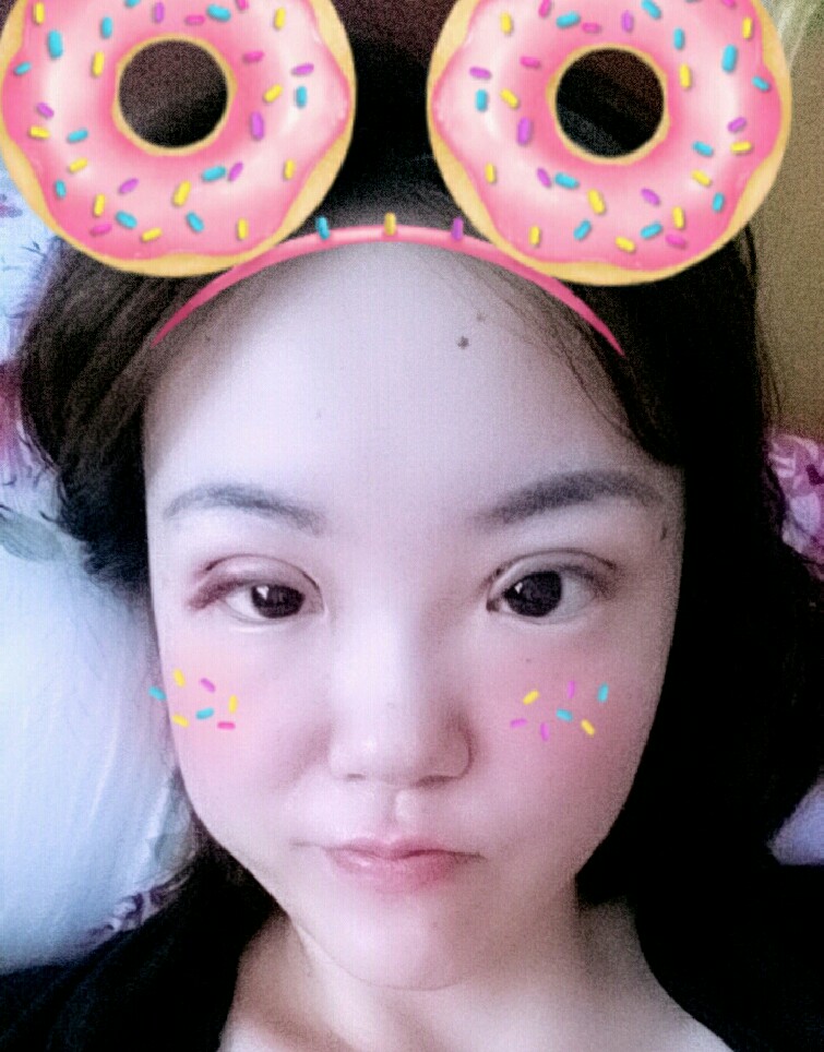 韩式三点双眼皮手术恢复过程对比照片
