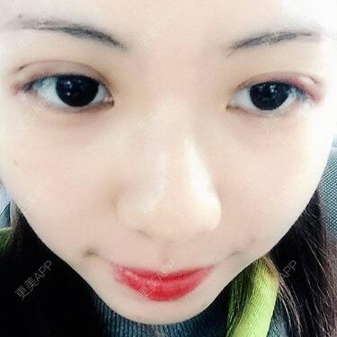 广州凯美达微创双眼皮手术恢复期纪实