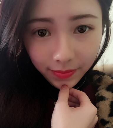 广州凯美达微创双眼皮手术恢复期纪实