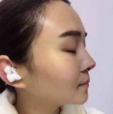 上海余天成二次鼻修复恢复日记 隆鼻整形修复+下巴吸脂