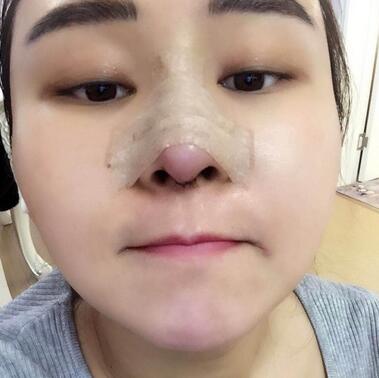 上海余天成二次鼻修复恢复日记 隆鼻整形修复+下巴吸脂