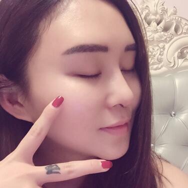 上海余天成二次鼻修复恢复日记 隆鼻整形修复+下巴吸脂