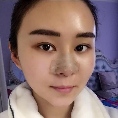 上海余天成二次鼻修复恢复日记 隆鼻整形修复+下巴吸脂