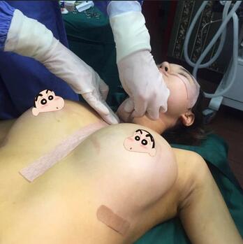 上海余天成自体脂肪隆胸70天恢复经历