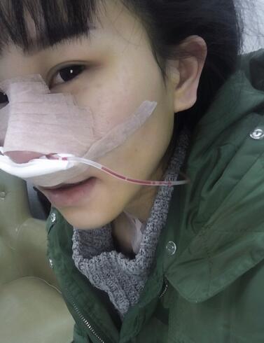 上海名仁膨体隆鼻+耳软骨垫鼻尖恢复日记