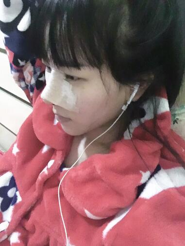 上海名仁膨体隆鼻+耳软骨垫鼻尖恢复日记
