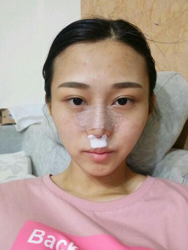 上海澳雅鼻小柱鼻中隔延长+耳软骨鼻尖2个月的照片