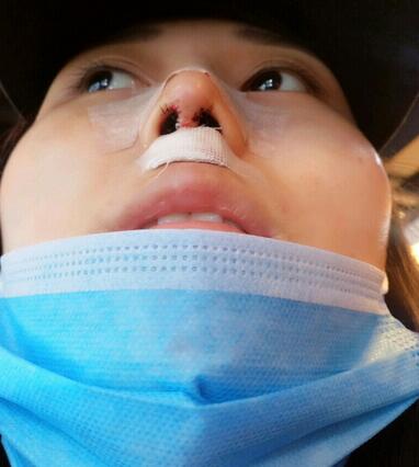 上海澳雅鼻小柱鼻中隔延长+耳软骨鼻尖2个月的照片