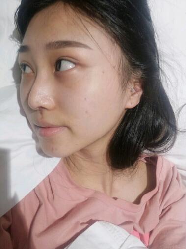 上海澳雅鼻小柱鼻中隔延长+耳软骨鼻尖2个月的照片