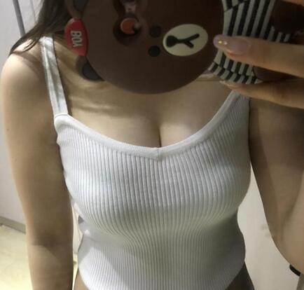 上海茸城自体脂肪隆胸60天