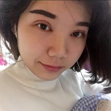 上海茸城切开双眼皮消肿过程图