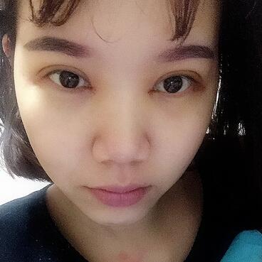 上海茸城切开双眼皮消肿过程图