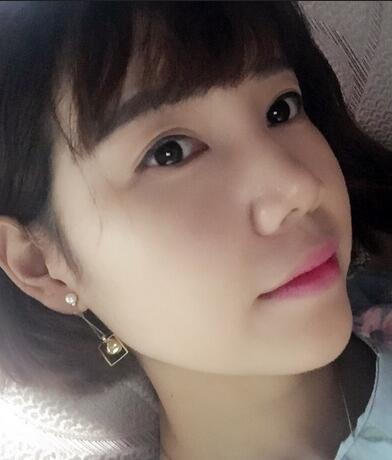 上海茸城切开双眼皮消肿过程图