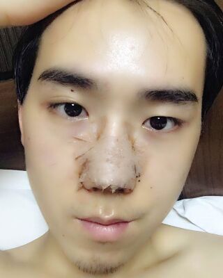 鼻子是朝天鼻的那种,鼻孔外露,非常不好看,很羡慕其他男生高挺又
