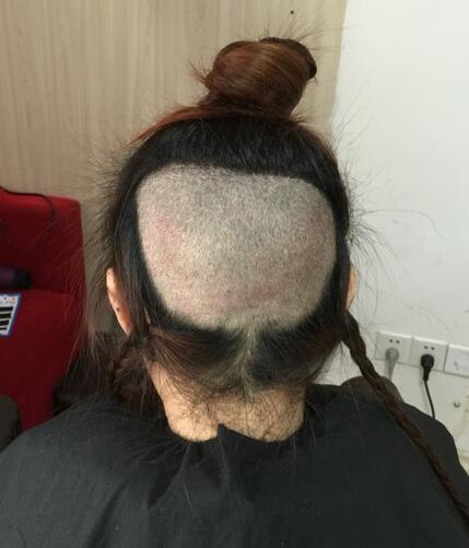 广州倍生女性发际线调整案例