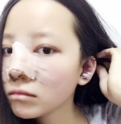 武汉爱美汇隆鼻整形恢复期图片