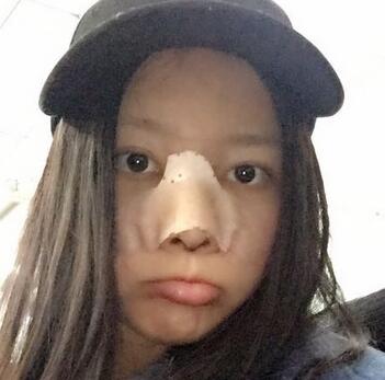 武汉爱美汇隆鼻整形恢复期图片