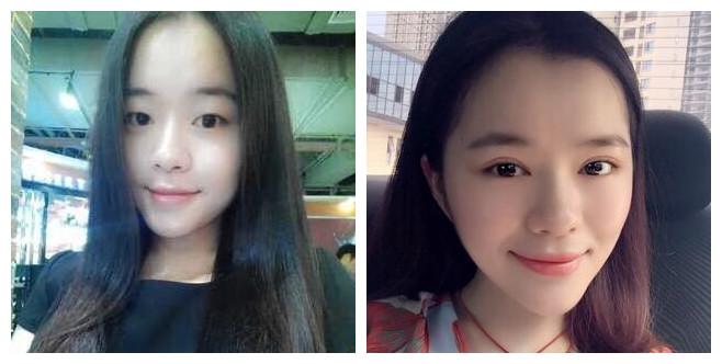 开内眼角多久恢复 开内眼角前后对比图