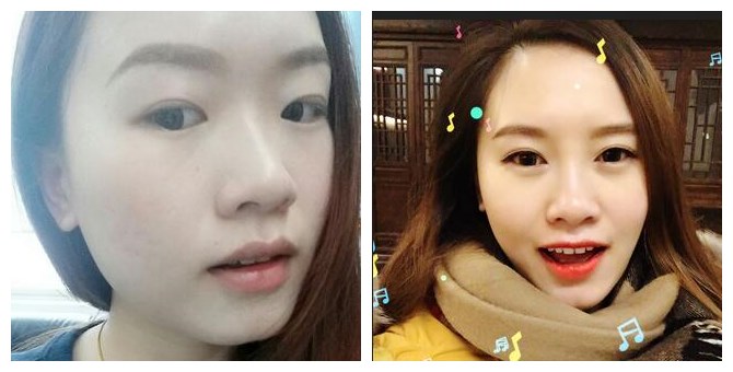 开内眼角多久恢复 开内眼角前后对比图