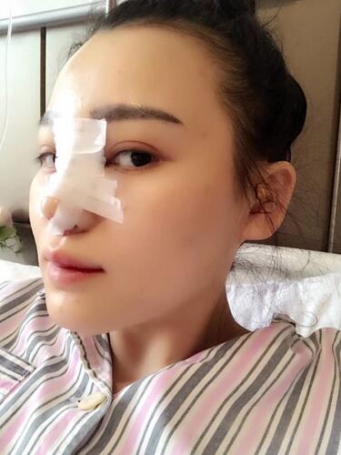上海九院李圣利隆鼻整形真实恢复期图片