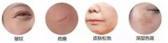 武汉医院做彩光嫩肤多少钱一次
