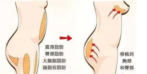 成都整形医院做自体脂肪丰臀一般需要多少钱