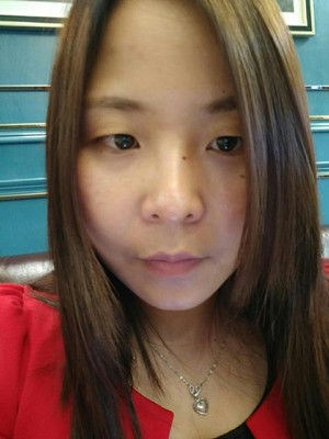 深圳南西子袁新平医生做的割双眼皮+开眼角前后恢复过程图片分享