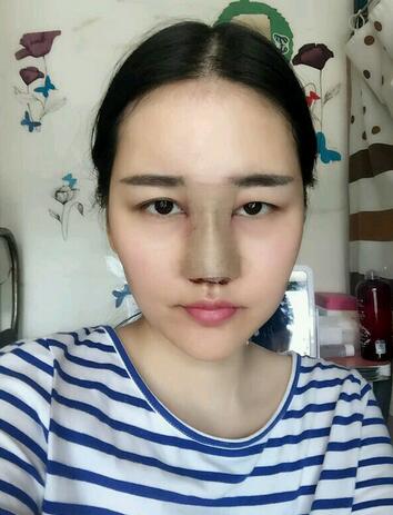 北京八大处范飞隆鼻整形案例