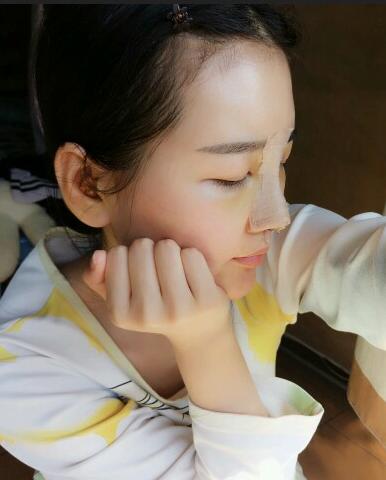 北京八大处范飞隆鼻整形案例