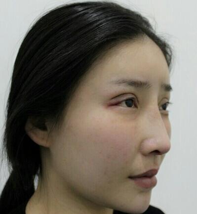 武汉西婵康美假体隆鼻+眼部综合整形