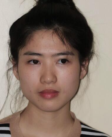 北京八大处下颌角截骨前后果对比