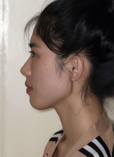 北京八大处下颌角截骨前后果对比