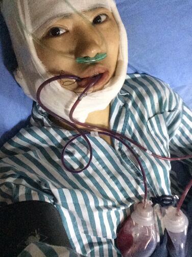 北京八大处下颌角截骨前后果对比