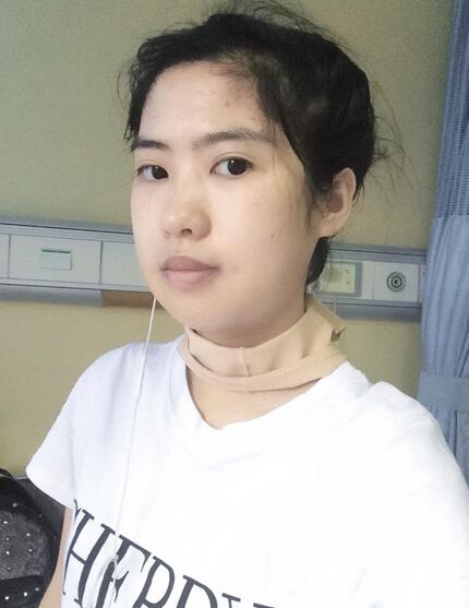 北京八大处下颌角截骨前后果对比