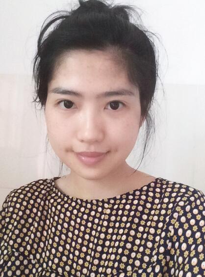 北京八大处下颌角截骨前后果对比