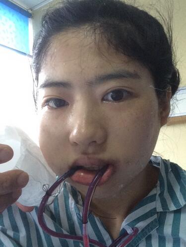 北京八大处下颌角截骨前后果对比