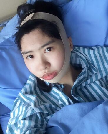 北京八大处下颌角截骨前后果对比