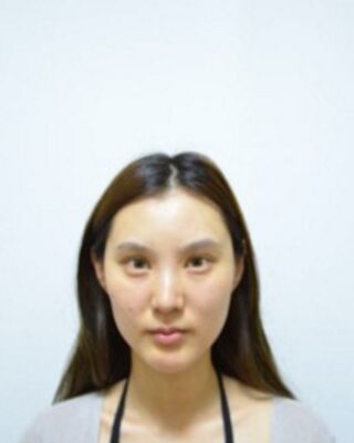 详细部自体脂肪填充恢复照片，北京京美真实案例