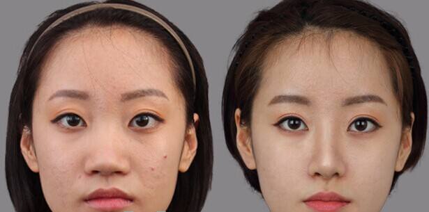 上海整形医院做鼻头缩小术多少钱