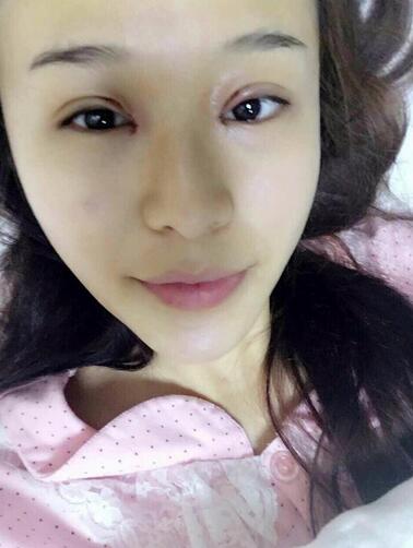 杭州大麦微针龙都整形开眼角+割双眼皮恢复记录