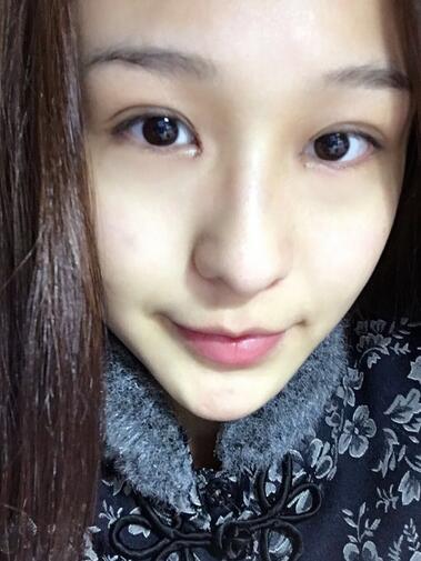 杭州大麦微针龙都整形开眼角+割双眼皮恢复记录