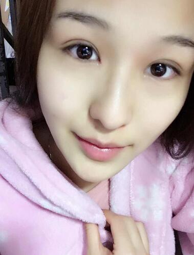 杭州大麦微针龙都整形开眼角+割双眼皮恢复记录